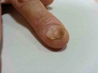 Aşırı Kansızlık Belirtileri ve Tedavisi