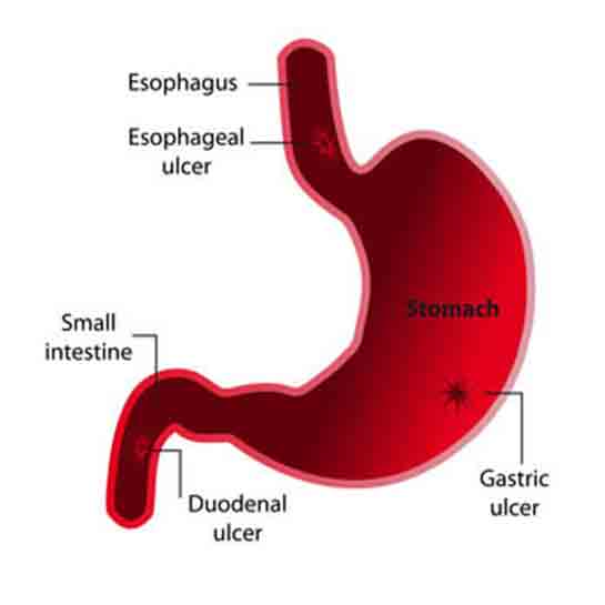 Gastrit Kanszlk Yaparm